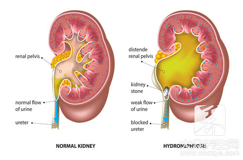 怎么会得肾结石病