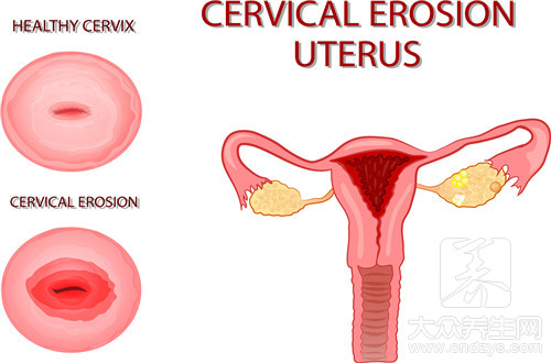 人乳头瘤病毒11型阳性