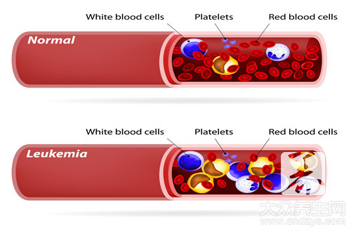 血常规如何排除白血病