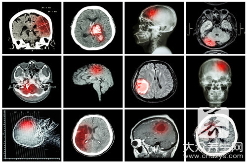 脑震荡后遗症吃什么药