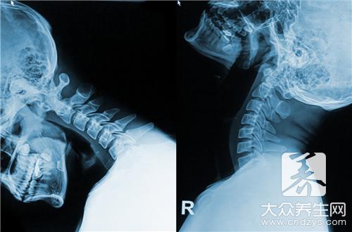 惊!牵一发而动全身 颈椎病诱发10种疾病