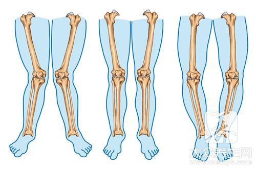 小腿外翻的矫正与治疗方法
