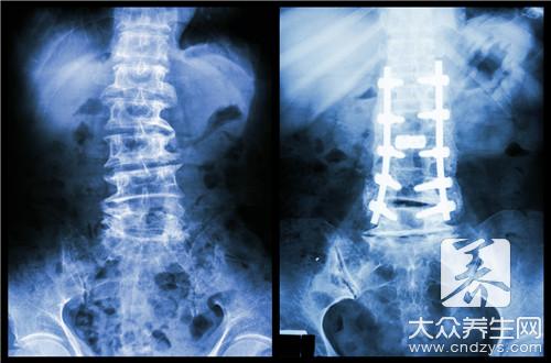 腰椎粉碎性骨折后遗症如何避免？