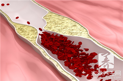 血粘度高的症状与危害