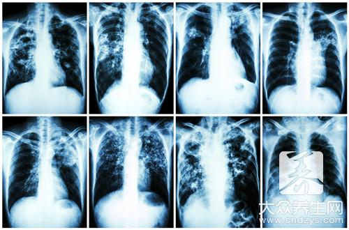 放射性肺炎 症状表现原来是这样