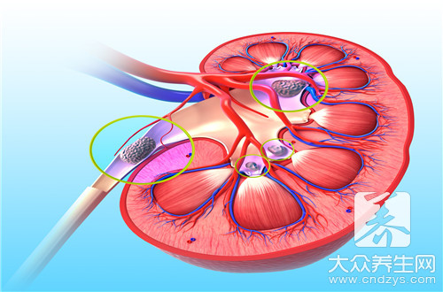 双肾结晶怎么办