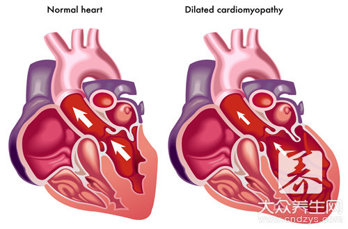 扩张性心肌病有救吗