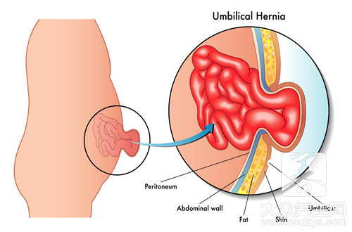小孩子疝气怎样治疗