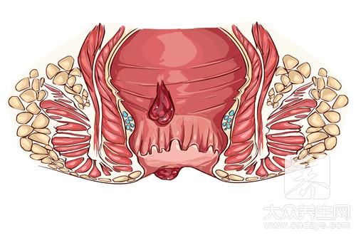 肛裂伤口不愈合怎么办 