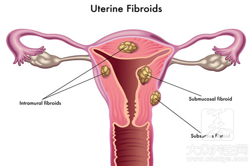 子宫肌瘤吃啥药 